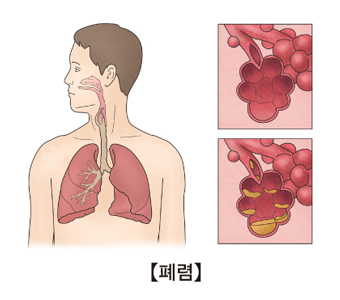 폐렴간균에 의한 폐렴
