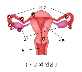 자궁외 임신