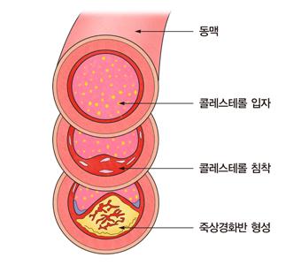 콜레스테롤로 인한 혈관 단면의 변화
