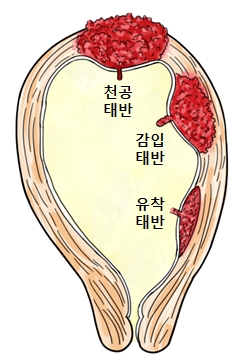 태반(Placenta) | 인체정보 | 의료정보 | 건강정보 | 서울아산병원